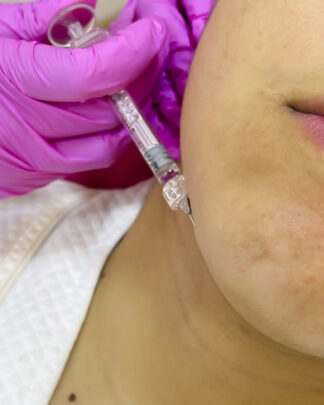 CONTORNO DEFINIDO – ÁCIDO HIALURÓNICO EN CONTORNO MANDIBULAR