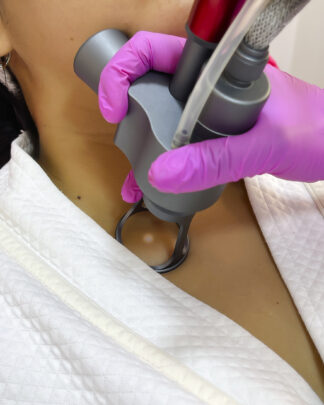SKINFIX CO2 - ELIMINAR ACROCORDONES