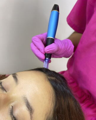 MESOTERAPIA FORTEX CAPILAR