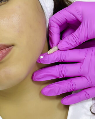 HILOS LISOS EN CONTORNO MANDIBULAR