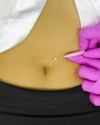 HILOS LISOS EN ABDOMEN