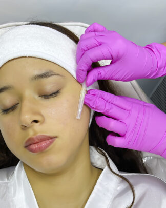 LIFTING FACIAL CON HILOS TENSORES