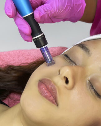MESOTERAPIA DESPIGMENTANTE FACIAL