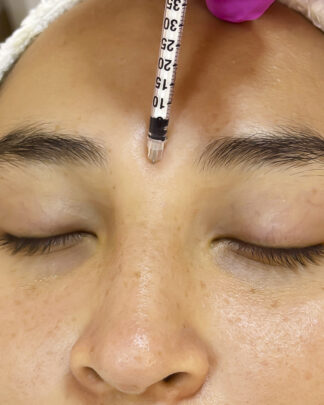 TOXINA BOTULÍNICA FULL FACE