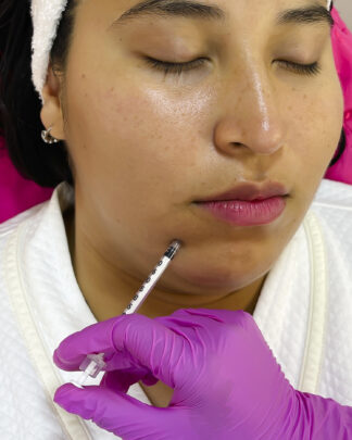 TOXINA BOTULÍNICA PARA SONRISA GINGIVAL