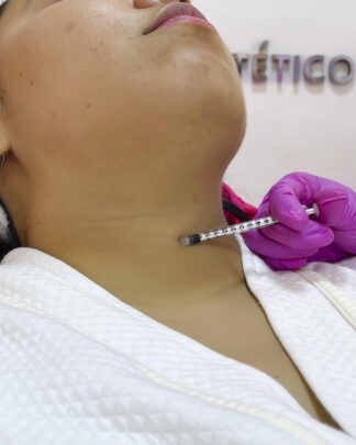TOXINA BOTULÍNICA EFECTO NEFERTITI - REJUVENECIMIENTO DE CUELLO