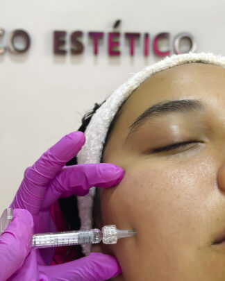 REJUVENECIMIENTO FACIAL CON BIOESTIMULADOR ELLANSÉ S