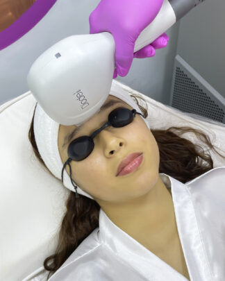 DEPILACIÓN LÁSER EN ROSTRO COMPLETO
