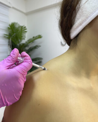 TOXINA BOTULÍNICA EN TRAPECIO