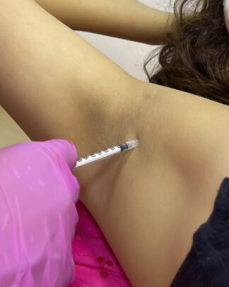 TOXINA BOTULÍNICA CONTRA LA HIPERHIDROSIS
