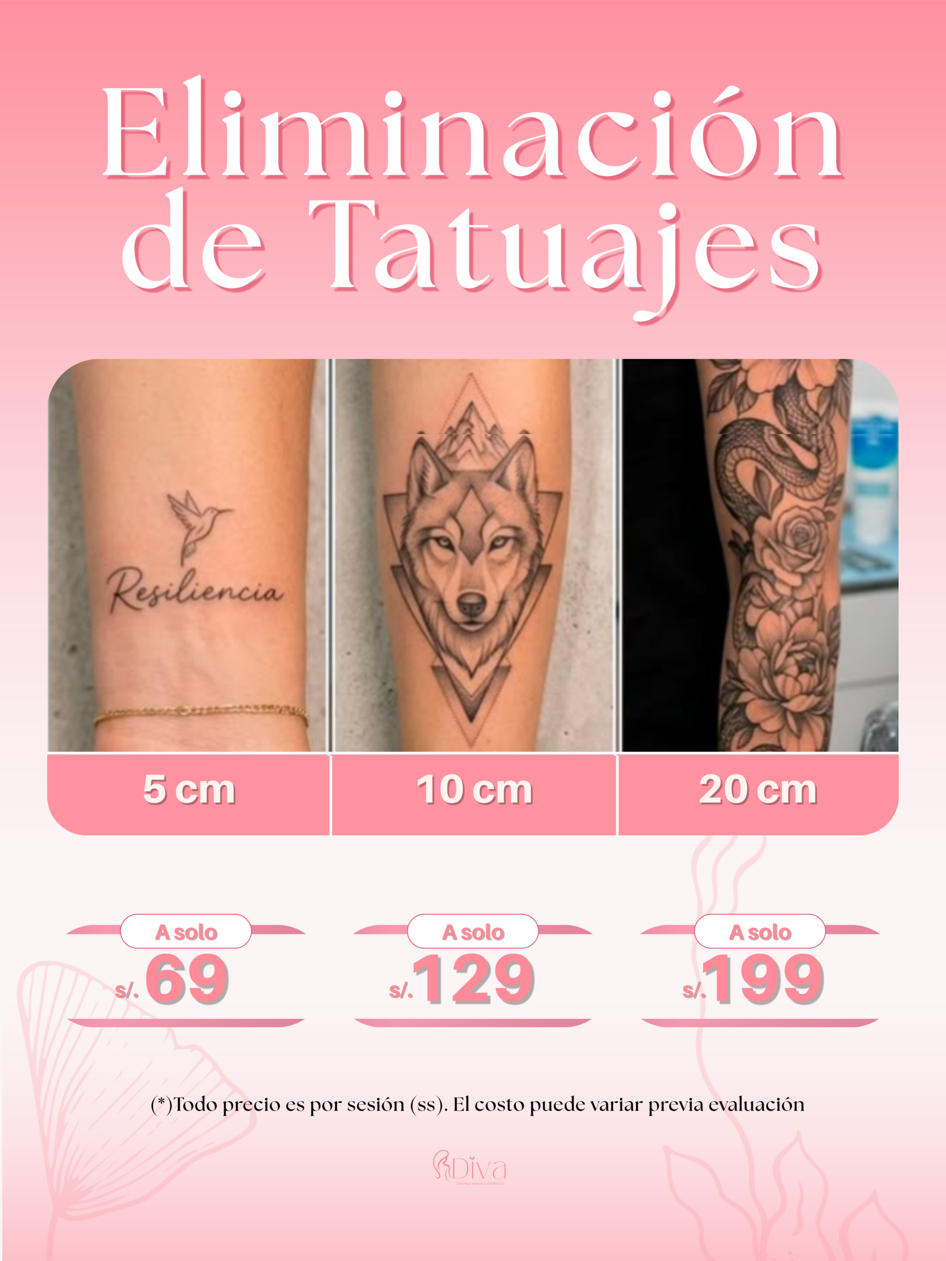 Eliminación de Tatuajes