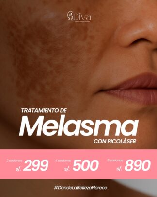 Tratamiento de Melasma con Picoláser