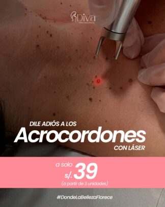 Eliminación de Acrocordones con Láser