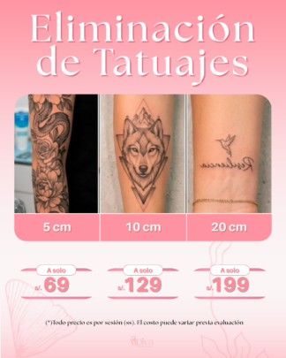 Eliminación de Tatuajes