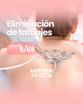 Eliminación de Tatuajes