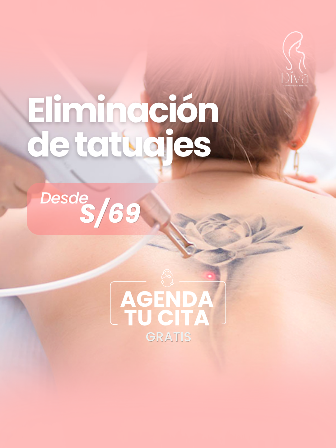 Eliminación de Tatuajes