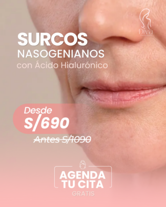 Ácido Hialurónico – Surcos Nasogenianos